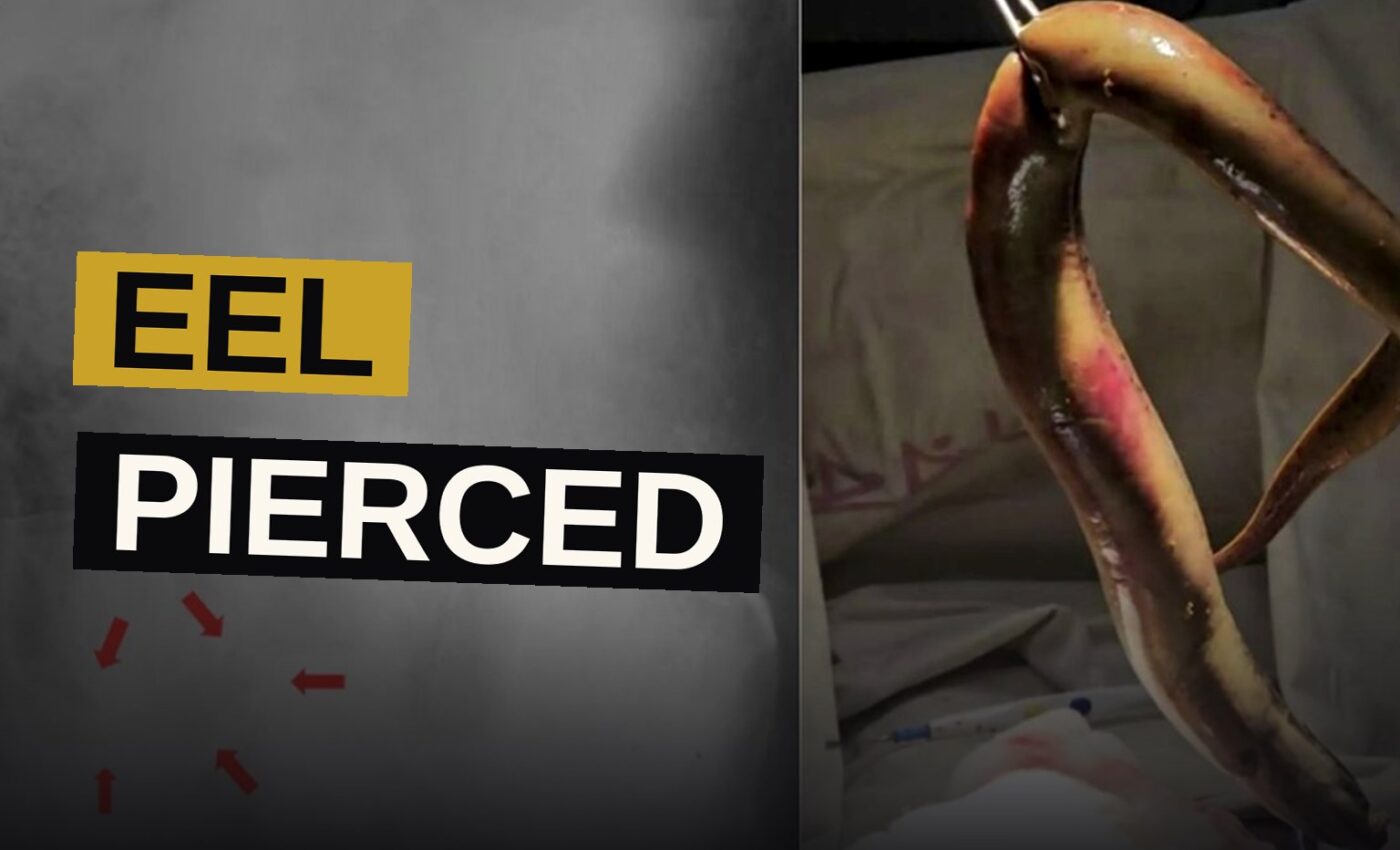 An X-ray reveals the shadow of a live eel lodged within a man's abdomen, the dread cause of his sudden agony.