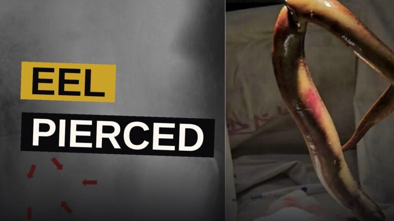 An X-ray reveals the shadow of a live eel lodged within a man's abdomen, the dread cause of his sudden agony.